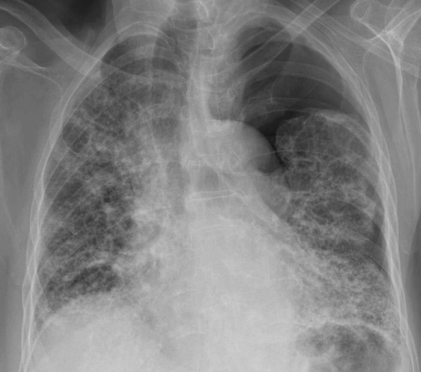 CXR Lossless