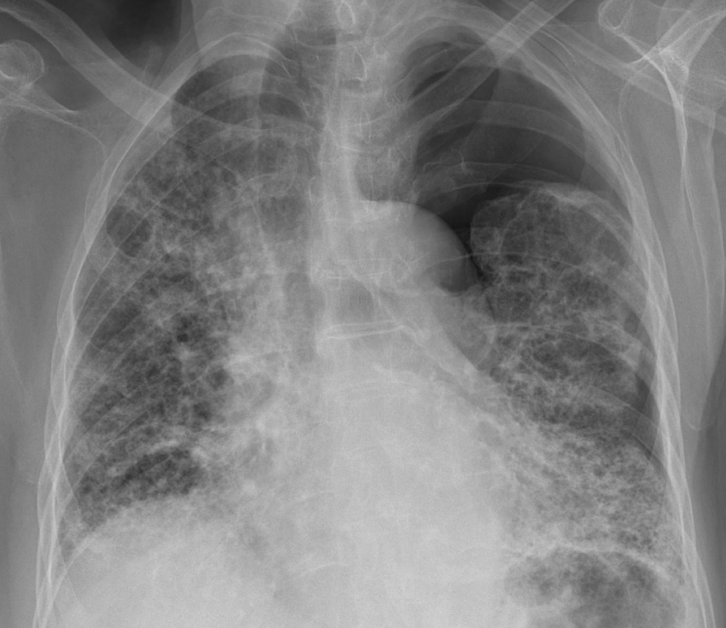 CXR Lossy